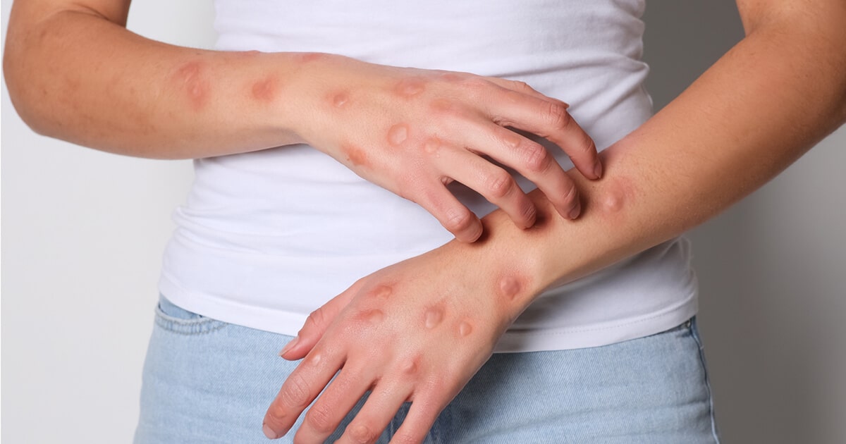 Mpox: Assessing Contact Risk Without Stigmatizing Partners